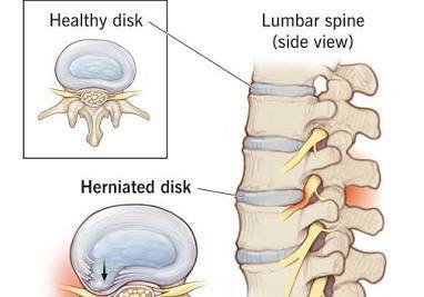 Herniated discs icon