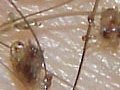 pubic-lice.jpg