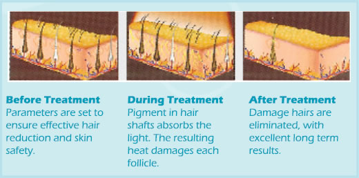 ipl-treatment-hair-removal-how-it-work.jpg
