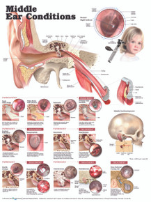 Reference Chart - Middle Ear Conditions