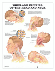 Reference Chart - Whiplash Injuries of the Head & Neck