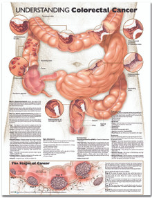 Reference Chart - Understanding Colorectal Cancer