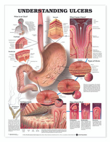 Reference Chart - Understanding Ulcers