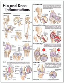 Reference Chart - Hip and Knee Inflammations