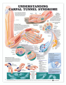 Reference Chart - Understanding Carpal Tunnel Syndrome