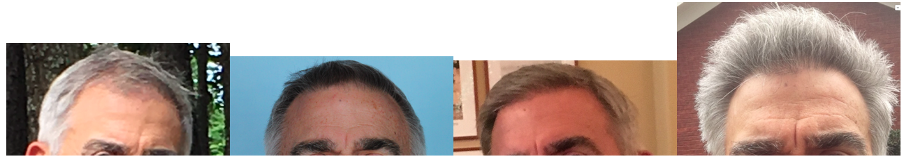 before-after-69-y-o-patient-of-dr-ed-griffin.png