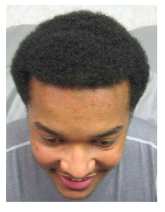 before after pictures with help hair shake on young african american male