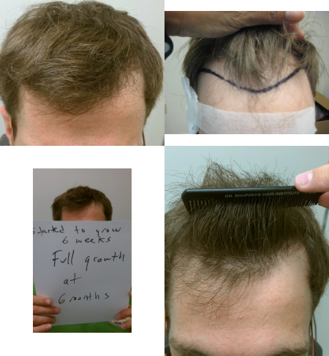 Faster regrowth after a hair transplant. Hair vitamins for fast hair growth. Accelerated Follicular Restoration