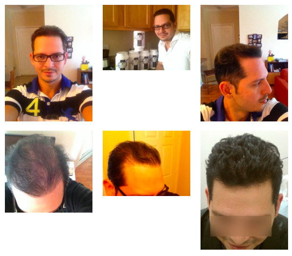 Effects Of Hrt Hormone Replacement Therapy On Hair Growth The
