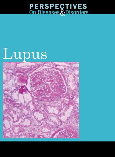 Lupus - 9780737747898 by Hayley Mitchell Haugen