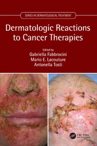 Dermatologic Reactions to Cancer Therapies by Gabriella Fabbrocini, Mario Lacouture, Antonella Tosti, 9781138633254