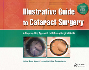 Illustrative Guide to Cataract Surgery (A Step-by-Step Approach to Refining Surgical Skills) by Amar Agarwal, 9781556429811
