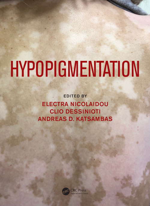 Hypopigmentation by Electra Nicolaidou, Clio Dessinioti, Andreas Katsambas, 9781138505230