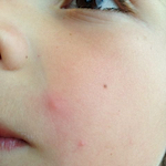 Picture of molluscum contagiosum on the face of a child.