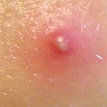 Large pus filled molluscum contagiosum lesion.
