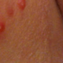 Treatment for atopic eczema dermatitis associated with molluscum contagiosum.