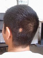 Why Is It That We Experience Hair Loss Body4real