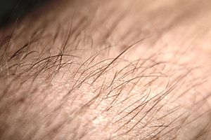 Hair Loss Due To Dihydrotestosterone Sensitive Hair Follicles