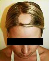 Hair Loss Among Youth Is On The Rise Body4real
