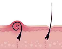 Ingrown Hair Problems Treat Them With Kalo Body4real