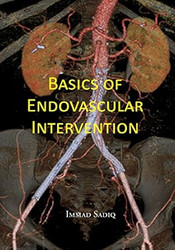 Basics of Endovascular Intervention
