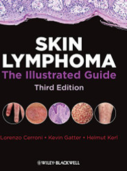 Skin Lymphoma