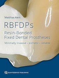 RBFDPs: Resin-Bonded Fixed Dental Prostheses: Minimally