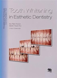 Tooth Whitening in Esthetic Dentistry