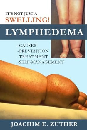 It's Not Just a Swelling! Lymphedema