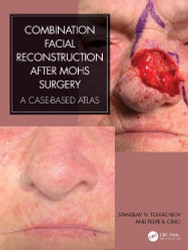 Combination Facial Reconstruction after Mohs Surgery