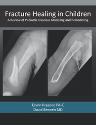 Fracture Healing in Children