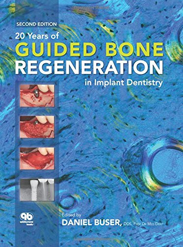 30 Years of Guided Bone Regeneration