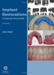 Implant Restorations