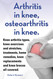 Arthritis in knee osteoarthritis in knee. Knee arthritis types knee