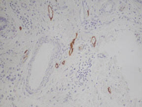 Rat anti Podoplanin 1:800 stained on human skin by Polink-2 Plus HRP Rat-NM DAB kit (Cat. No. D46-18)