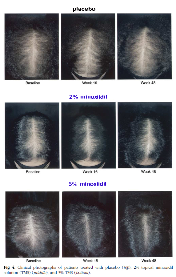 15% minoxidil before and after