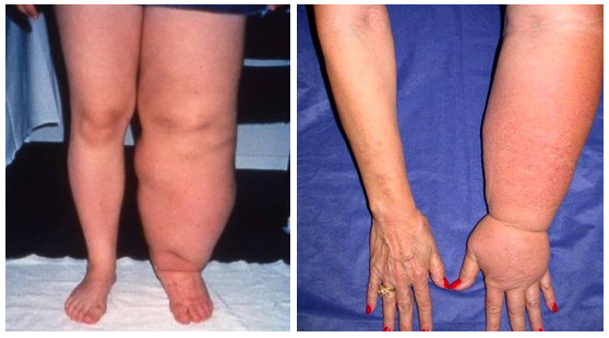 lymphedema.jpg lymphedema.jpg