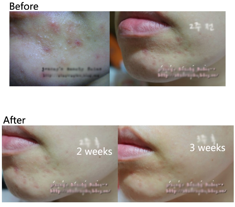 ciracle-red-spot-cream-30ml-trouble-skin-pimple-acne-anti-blemish-68924.1435992974.1280.1280.jpg