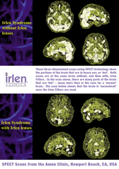 Amen Brain SPECT Poster (Available in 2 sizes)