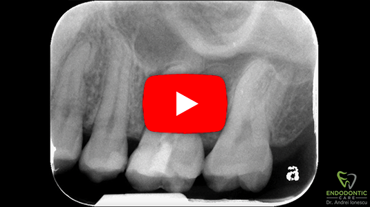 Endodontist Dr. Andrei Ionescu BSc, DMD, MSc (Endodontics) shows how to use the San Diego Swiss IRS® Superior Edition™ Instrument Removal System in a detailed video case study.