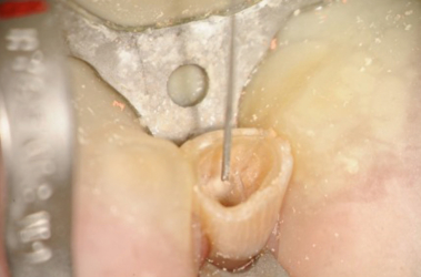 Erbium YAG Laser to Help Disinfect Dentin