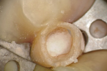 Pellet of Sodium Perborate for Bleaching in Tooth