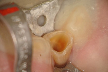 Rubber Dam Placed and Caries Removal