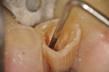 Gutta Purcha Removed to 12mm with Ultrasonic