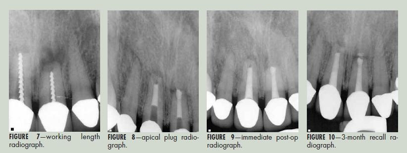 Rips, Strips and Broken Tips: Part III: Treating the Untreatable – A Case Report, Steven J. Cohen DDS, Cert. Endo.